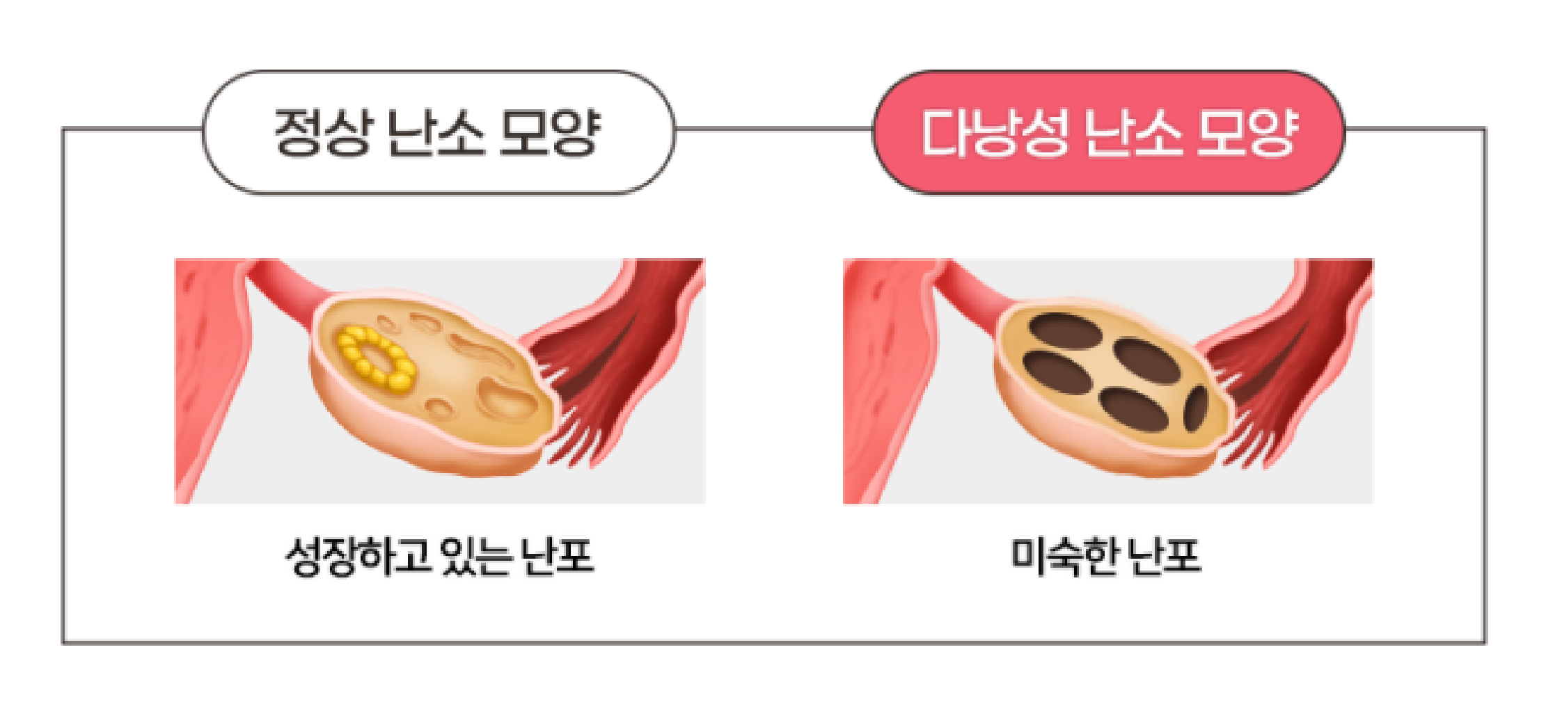다낭성 난소 모양 이미지